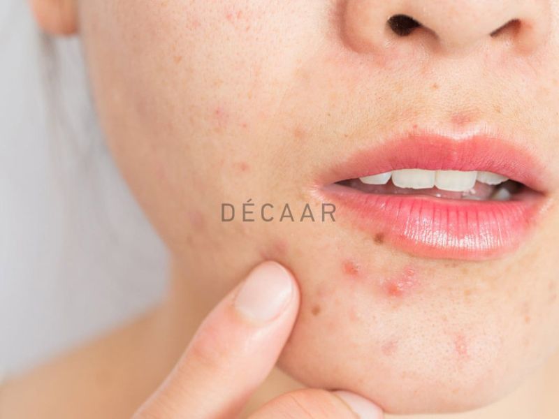 Có nhiều nguyên nhân bị mụn viêm ở má